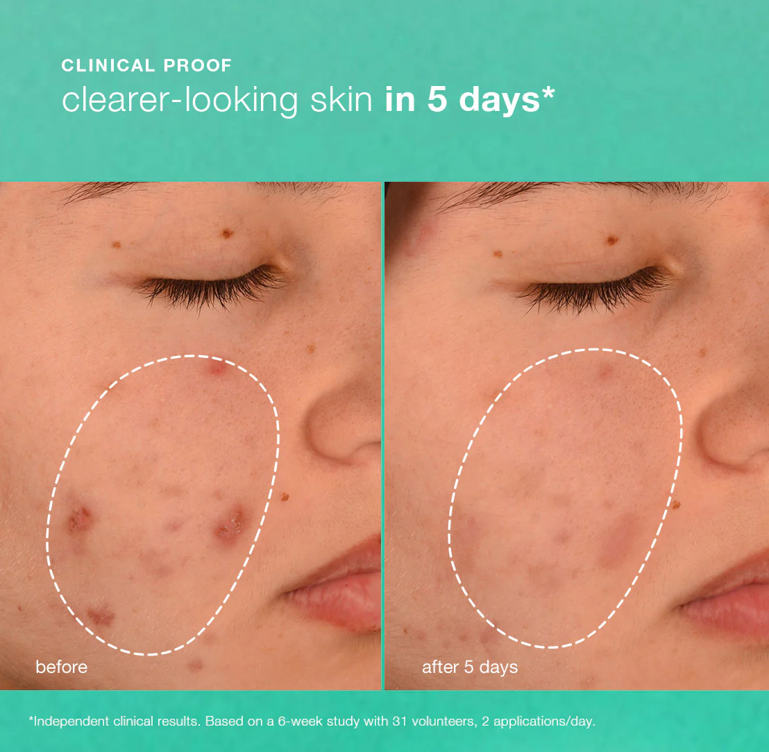 breakout biotic moisturizer - Image 4